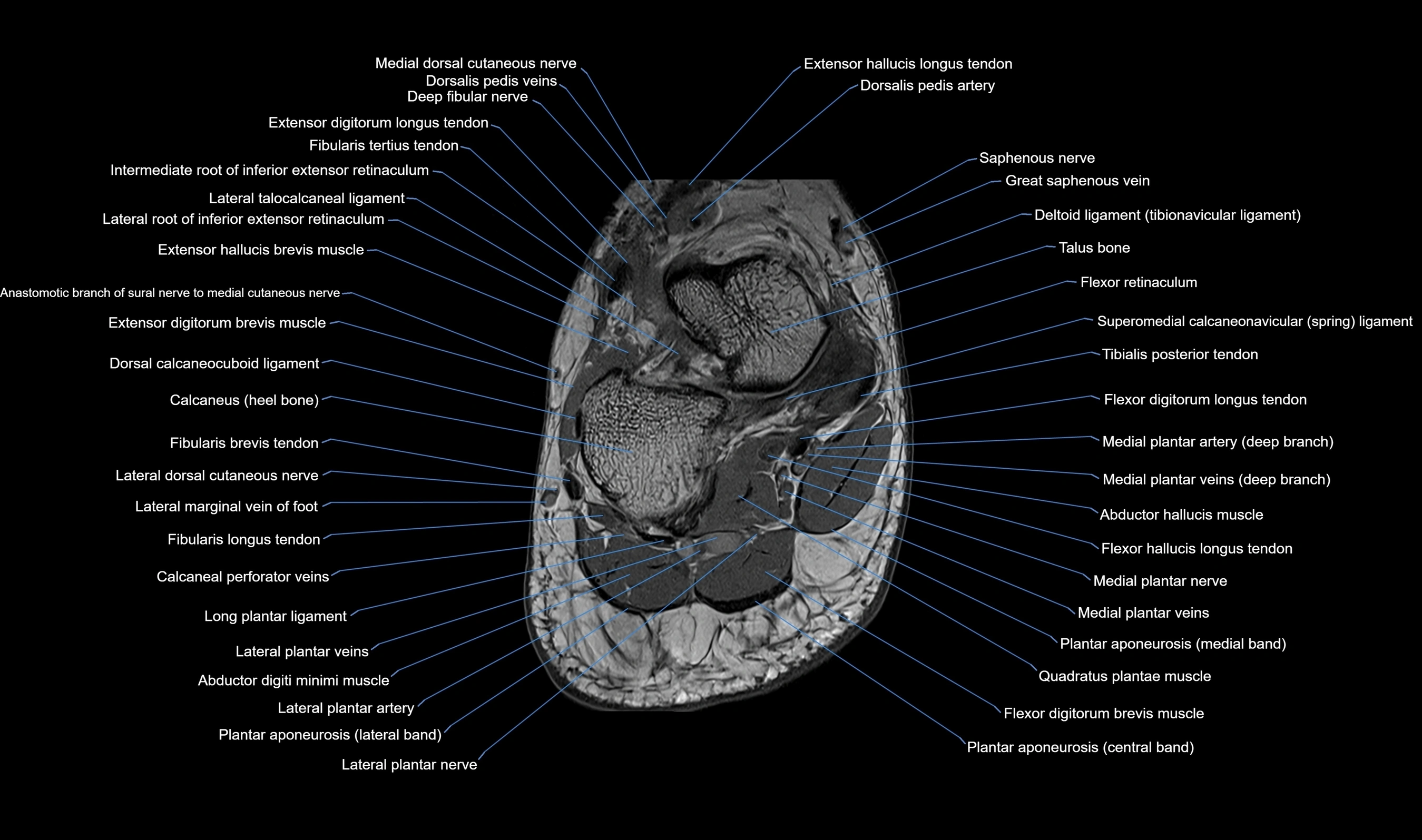 MRI mid foot axial cross sectional anatomy 3T  radiology  image-img-00001-00039.webp